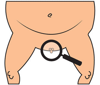 Micropenis